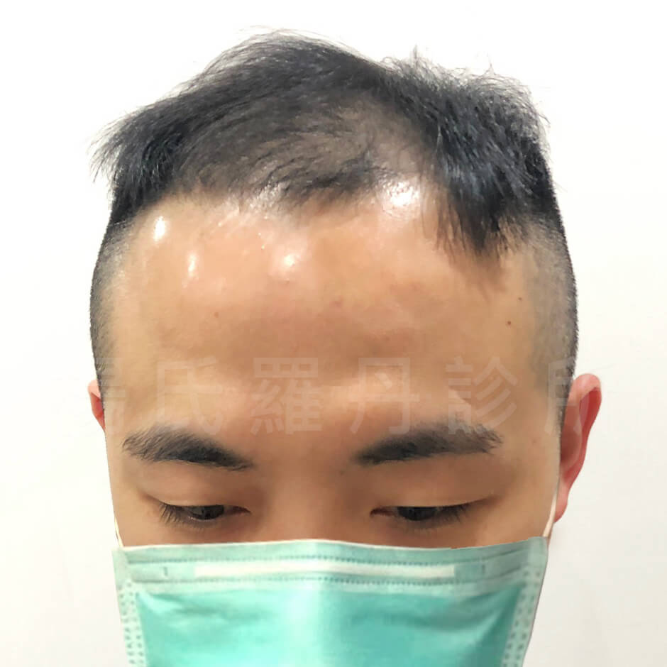 生髮613 複合式生髮 植髮 禿頭 掉髮